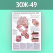 Плакат «Хроническая обструктивная болезнь легких (ХОБЛ)» (ЗОЖ-49, ламинир. бумага, А1, 1 лист)